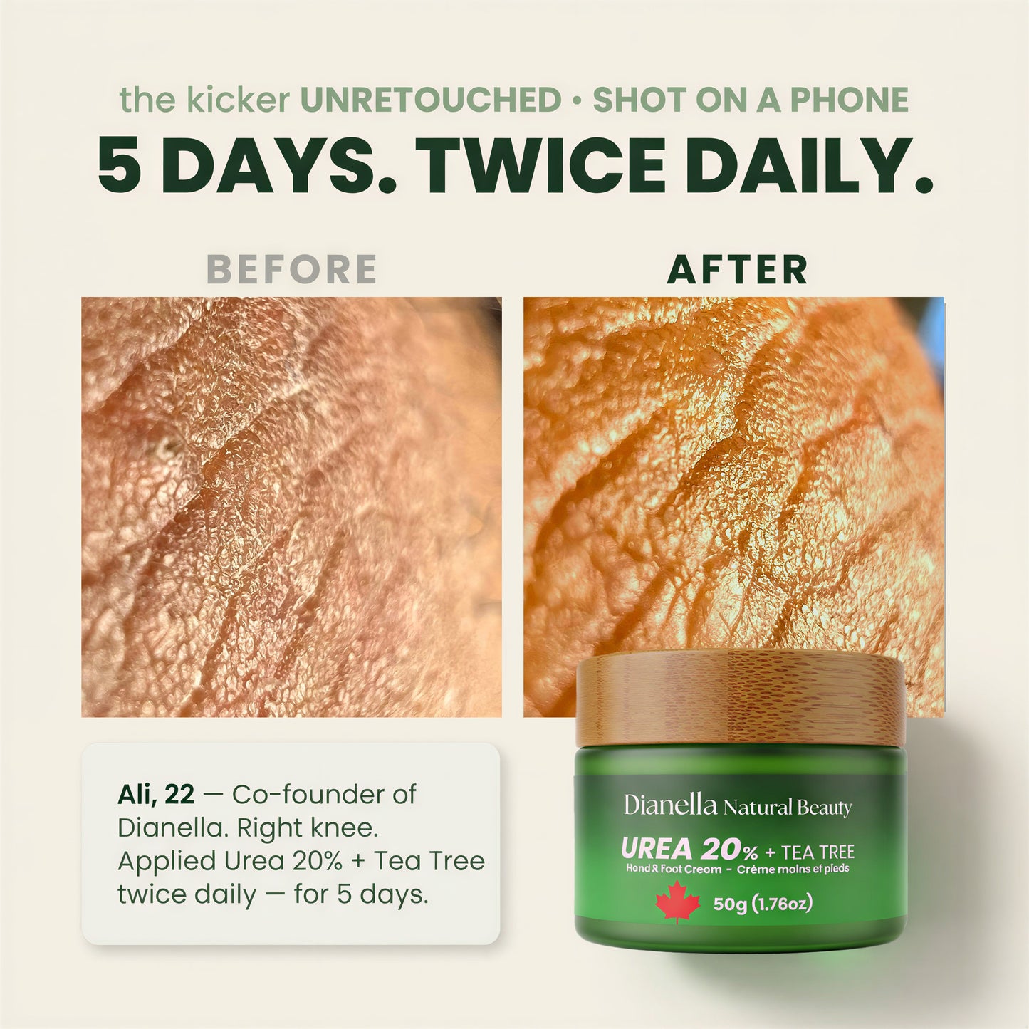 Urea 20% + Tea Tree ‎ ‎ ‎‎‎ ‎‎‎ ‎ ‎Hand & Foot Cream