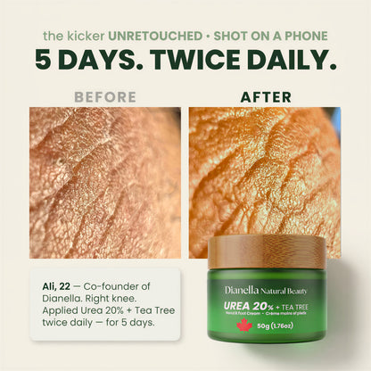 Urea 20% + Tea Tree ‎ ‎ ‎‎‎ ‎‎‎ ‎ ‎Hand & Foot Cream